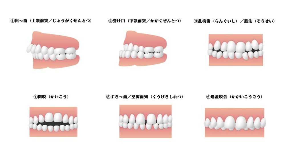 歯科矯正治療をおすすめする歯並び