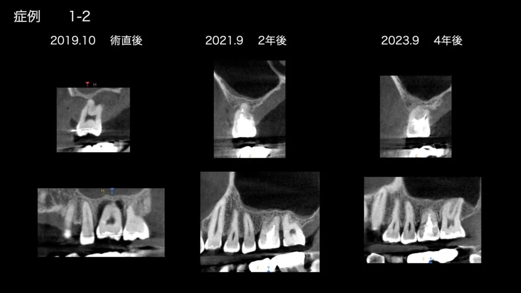 自家歯牙移植症例②