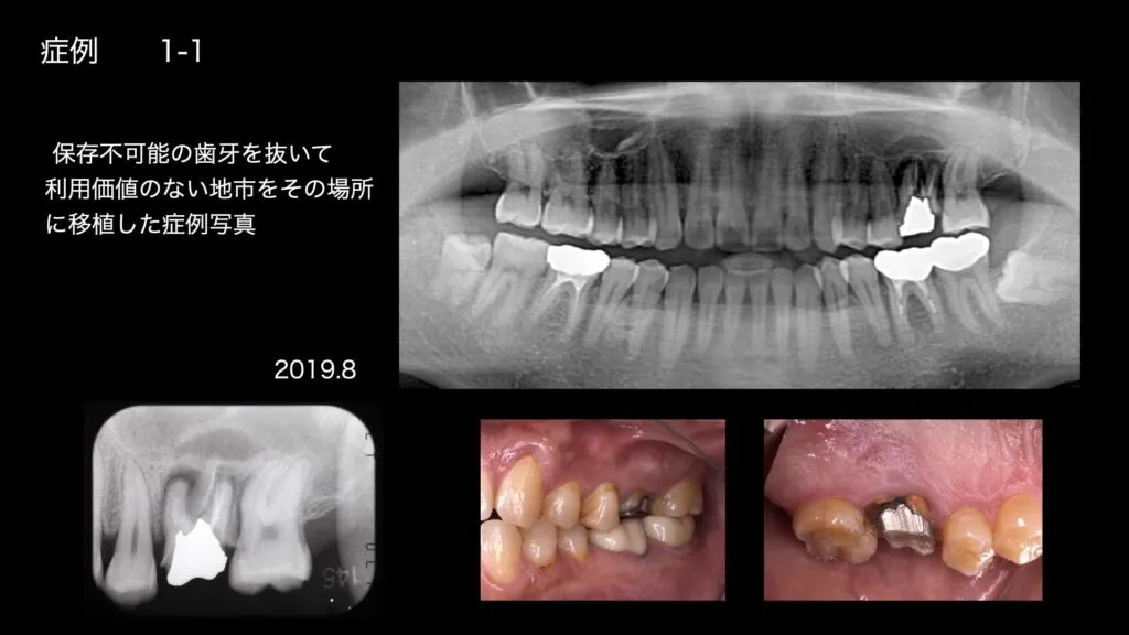 自家歯牙移植症例①